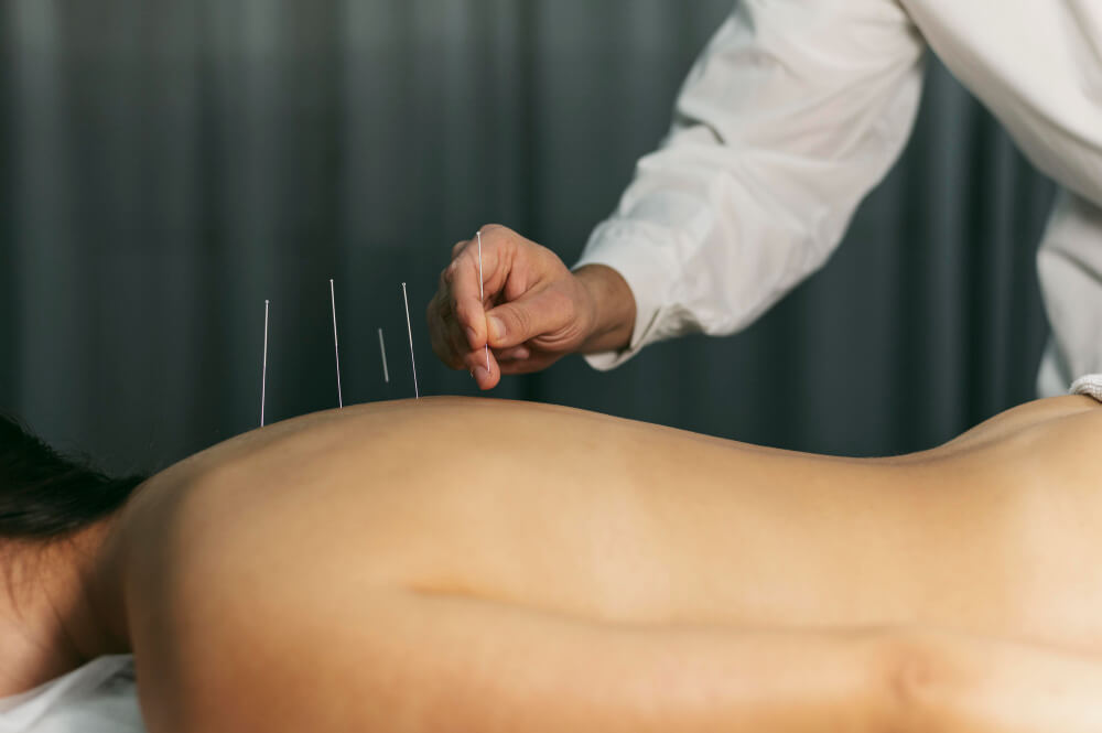 tcm acupuncture