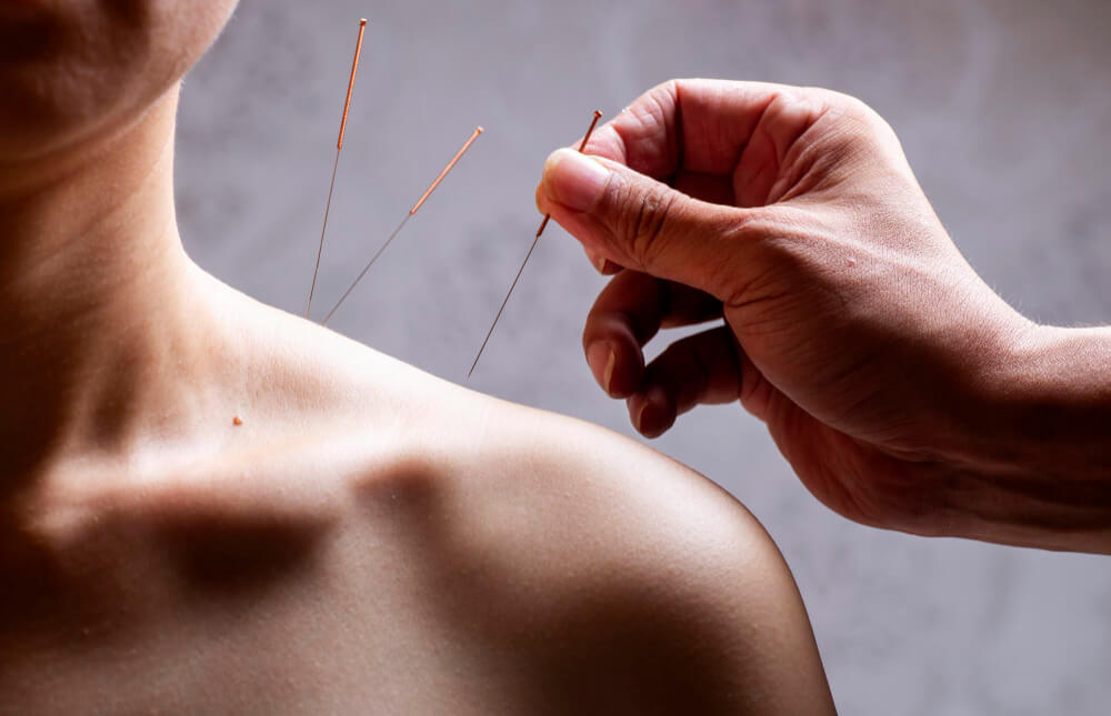 thin noodles insert into skin tcm acupuncture