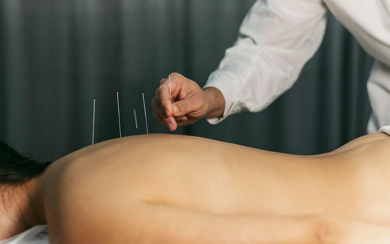 Acupuncturist inserting needles into a patient's upper back for treatment.