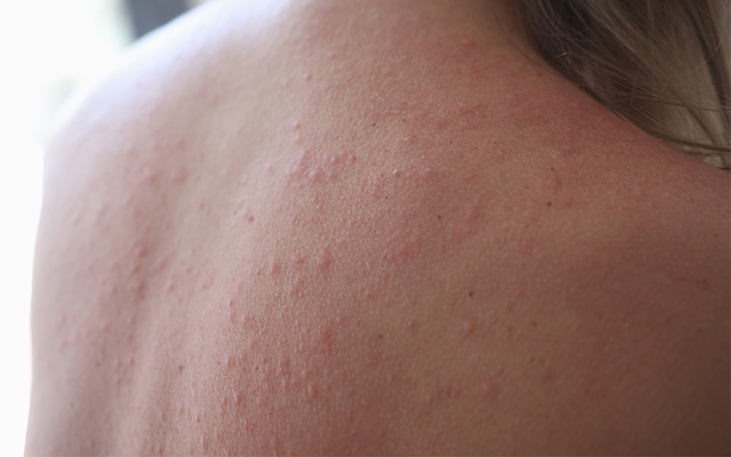 Skin rash or bumps, possible acupuncture detox symptoms